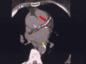Coronary Artery CT with Calcification